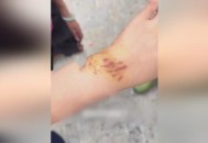 被鲨鱼咬后炫耀伤口,被鲨鱼咬后炫耀伤口怎么办