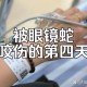 救助眼镜蛇反被咬伤,人被眼镜蛇咬伤会出现哪些症状？