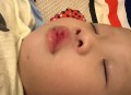 亲10月龄娃脚后嘴肿,小孩崴到脚并且肿？