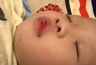 亲10月龄娃脚后嘴肿,小孩崴到脚并且肿？