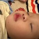 亲10月龄娃脚后嘴肿,小孩崴到脚并且肿？
