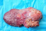 患癌肝被肿瘤占近半,癌症转移到肝能活多久？