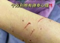 咬破手指写字求救,急急急急急求助猫咪被野猫咬伤怎么处理？