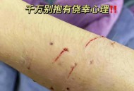 咬破手指写字求救,急急急急急求助猫咪被野猫咬伤怎么处理？