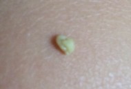 喉咙痛咽喉长满雪花,喉咙疼带血还有臭臭的小颗粒