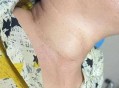 脖子长瘤跟头一样大,一个脖子跟头有多少厘米高？