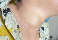 脖子长瘤跟头一样大,一个脖子跟头有多少厘米高？