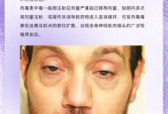 31名娃肉毒杆菌中毒,31名娃肉毒杆菌中毒死亡