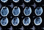 做微创手术脑致死亡,做微创手术脑致死亡赔偿多少
