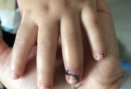 女童指尖被夹断,小孩指尖被夹断