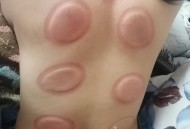 连拔2天火罐致截瘫,萨满罐效果到底怎么样？