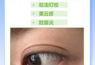 贷款美容店消费91万,眼睑上长了个小疙瘩怎么处理？