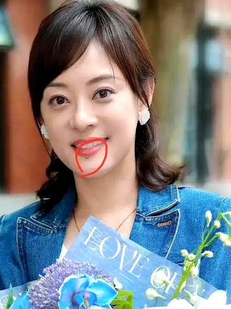 孙俪唇下痣没了,孙俪唇下痣是后来有的吗?