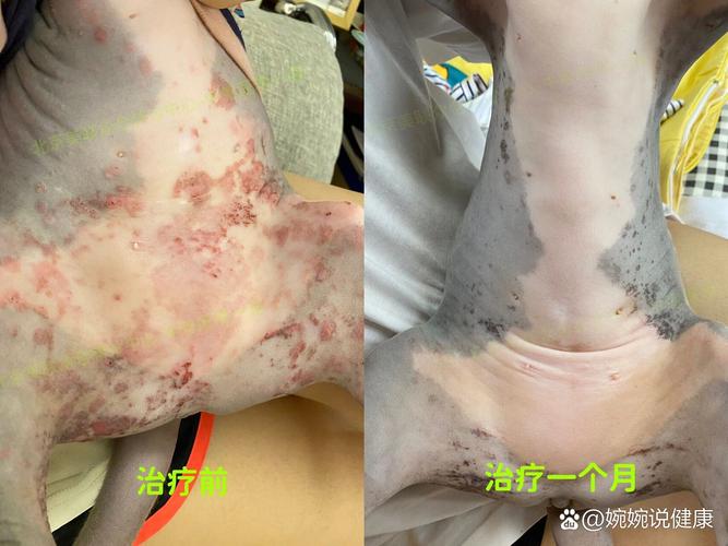 美公园枪击7人受伤,长沙7岁女童公园游玩时被蚊虫“盯上”,长了满腿的丘疹性荨麻疹, 你怎么看?