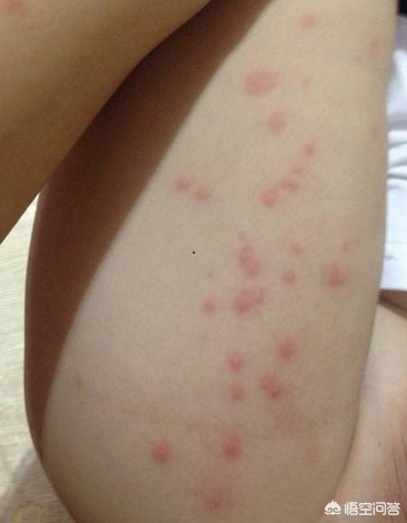 美公园枪击7人受伤,长沙7岁女童公园游玩时被蚊虫“盯上”,长了满腿的丘疹性荨麻疹, 你怎么看? 美公园枪击7人受伤,长沙7岁女童公园游玩时被蚊虫“盯上”,长了满腿的丘疹性荨麻疹, 你怎么看?