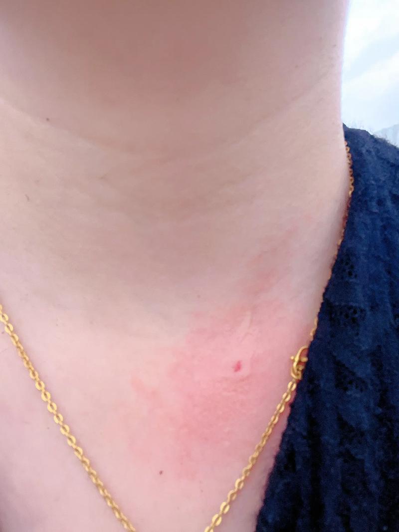 脖子被扎多根烧烤签,被烧烤签子扎出血了