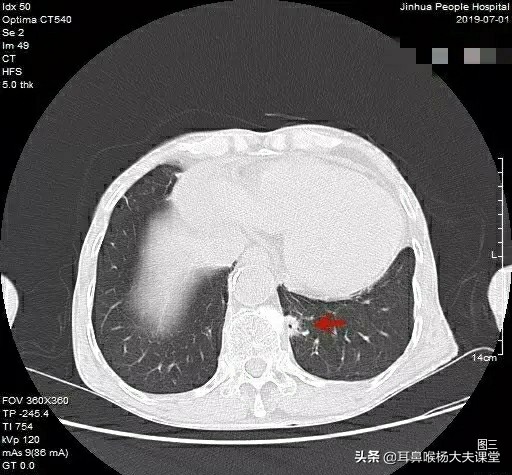 抗癌2年后发现误诊,癌症病理检查什么时候会出现误诊,怎么办? 抗癌2年后发现误诊,癌症病理检查什么时候会出现误诊,怎么办?