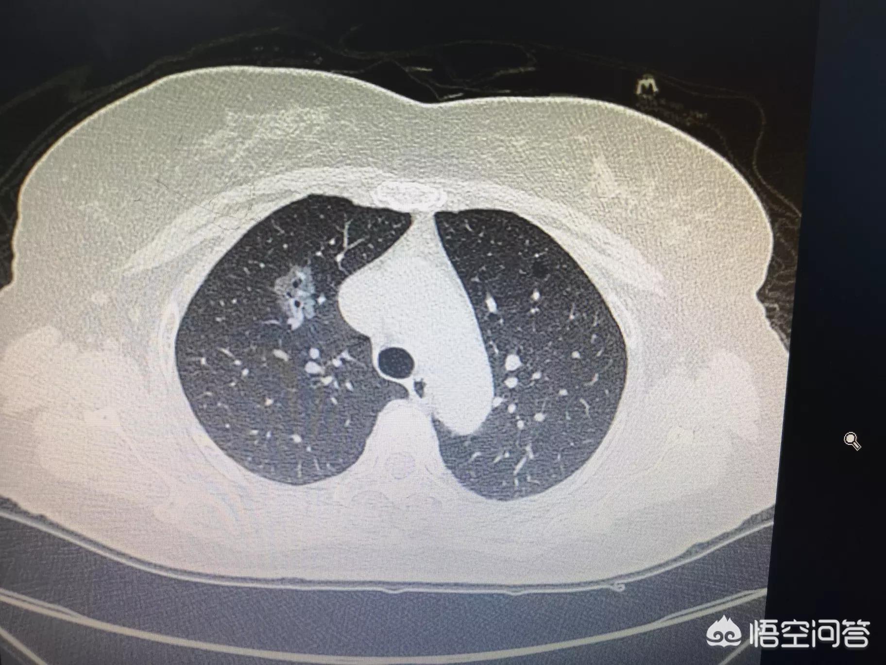 为全家做饭确诊肺癌,家庭主妇长期做饭会得肺癌吗？