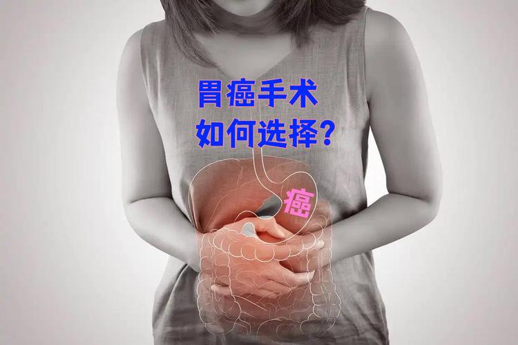 胃炎被当癌症切全胃,胃炎切胃能活多久