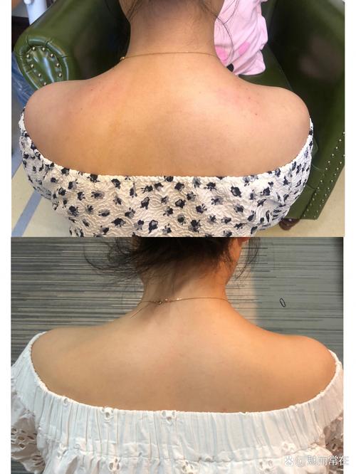 女子打瘦肩针险丧命,有打过瘦肩针的美女吗