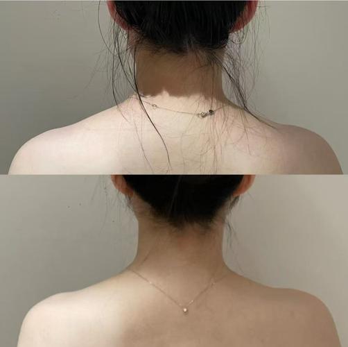 女子打瘦肩针险丧命,瘦肩针多久效果明显?