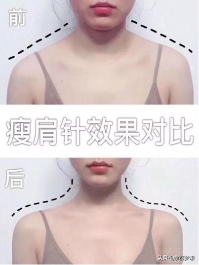 女子打瘦肩针险丧命,瘦肩针多久效果明显? 女子打瘦肩针险丧命,瘦肩针多久效果明显?