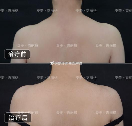 女子打瘦肩针险丧命,瘦肩薄背针可以保多久?