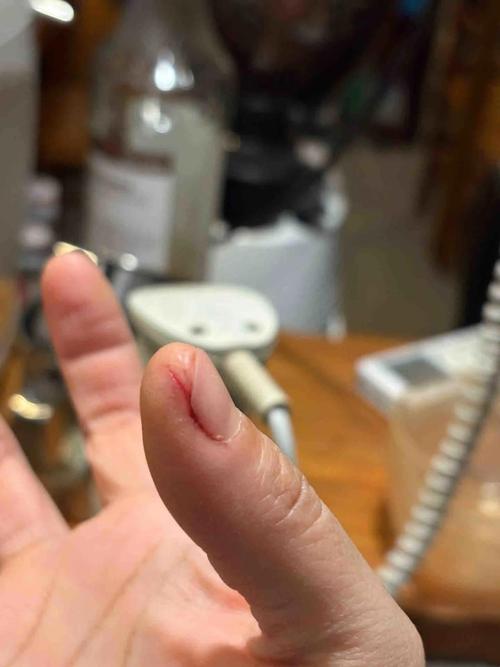 湖北2.5天休假遇冷,整个手突然脱皮是什么原因