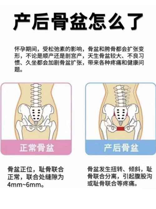 女性盆骨正在缩小,顺产生完怎么缩小骨盆?