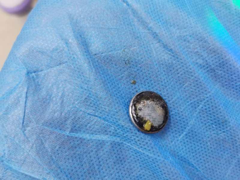 2岁娃误吞纽扣电池,两岁宝宝误吞纽扣电池