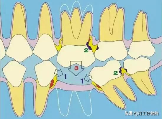 牙周炎一次拔14颗牙,牙周病到什么样的程度牙必须拔除? 牙周炎一次拔14颗牙,牙周病到什么样的程度牙必须拔除?