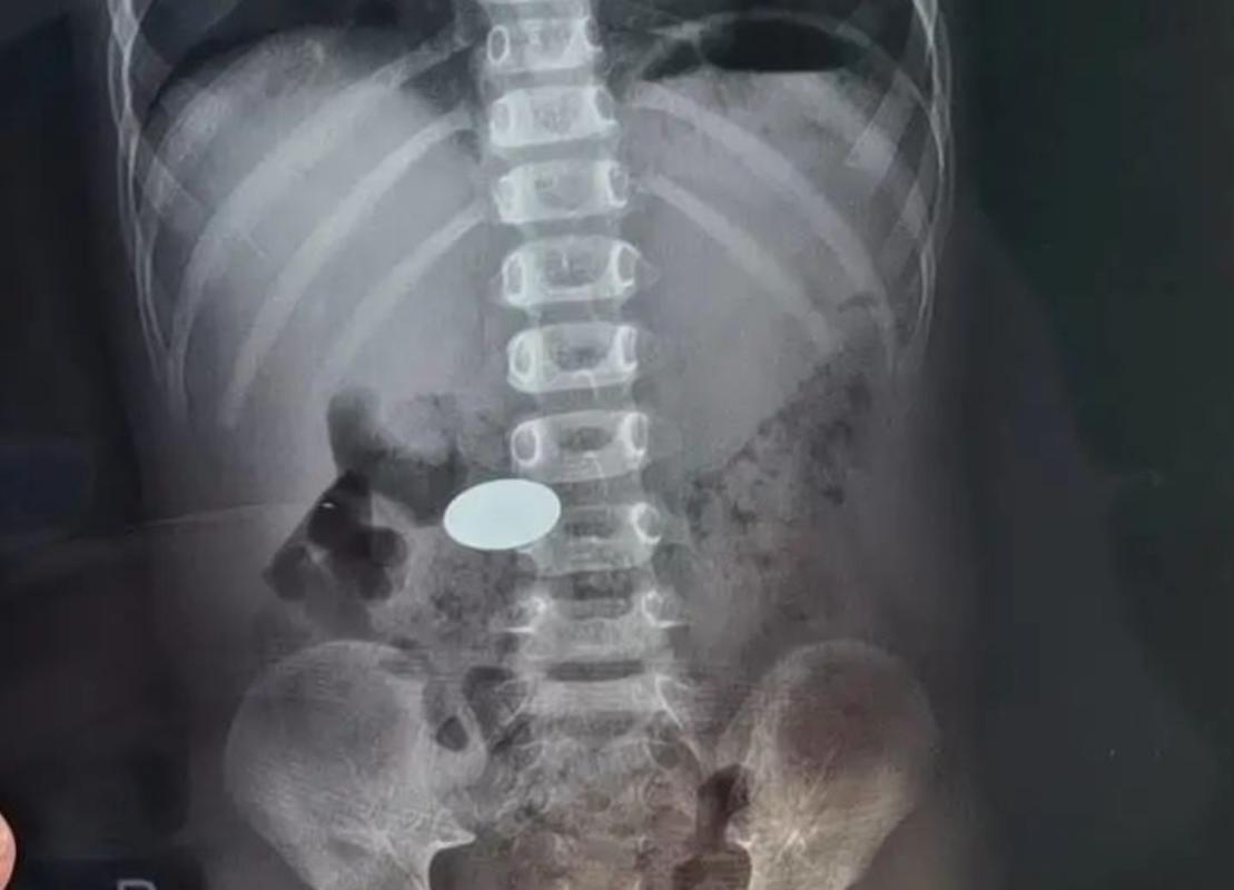 男童误吞遥控器电池,遥控器吃电是怎么回事?