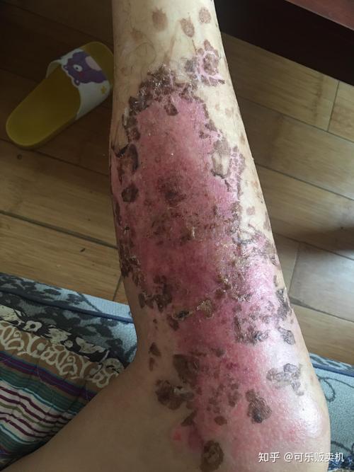 做艾灸致2度烫伤,做艾灸致2度烫伤严重吗