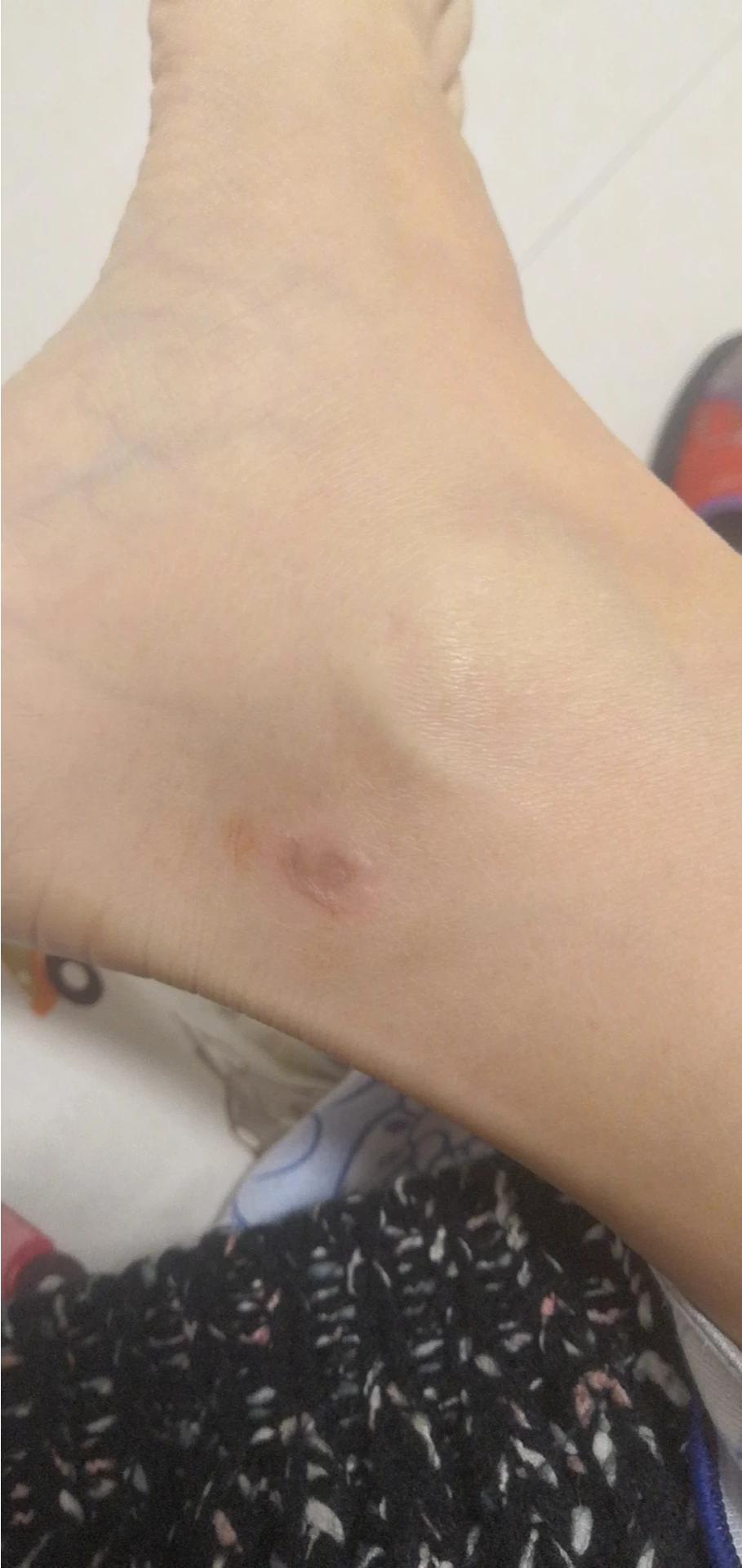 做艾灸致2度烫伤,艾灸烫伤后疼痛和发白是感染吗？