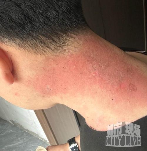 做艾灸致2度烫伤,艾灸严重烫伤