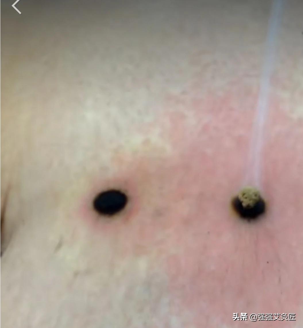 做艾灸致2度烫伤,艾灸不小心把足三里烫伤了，目前长了一圈红疙瘩，继续还是停止？