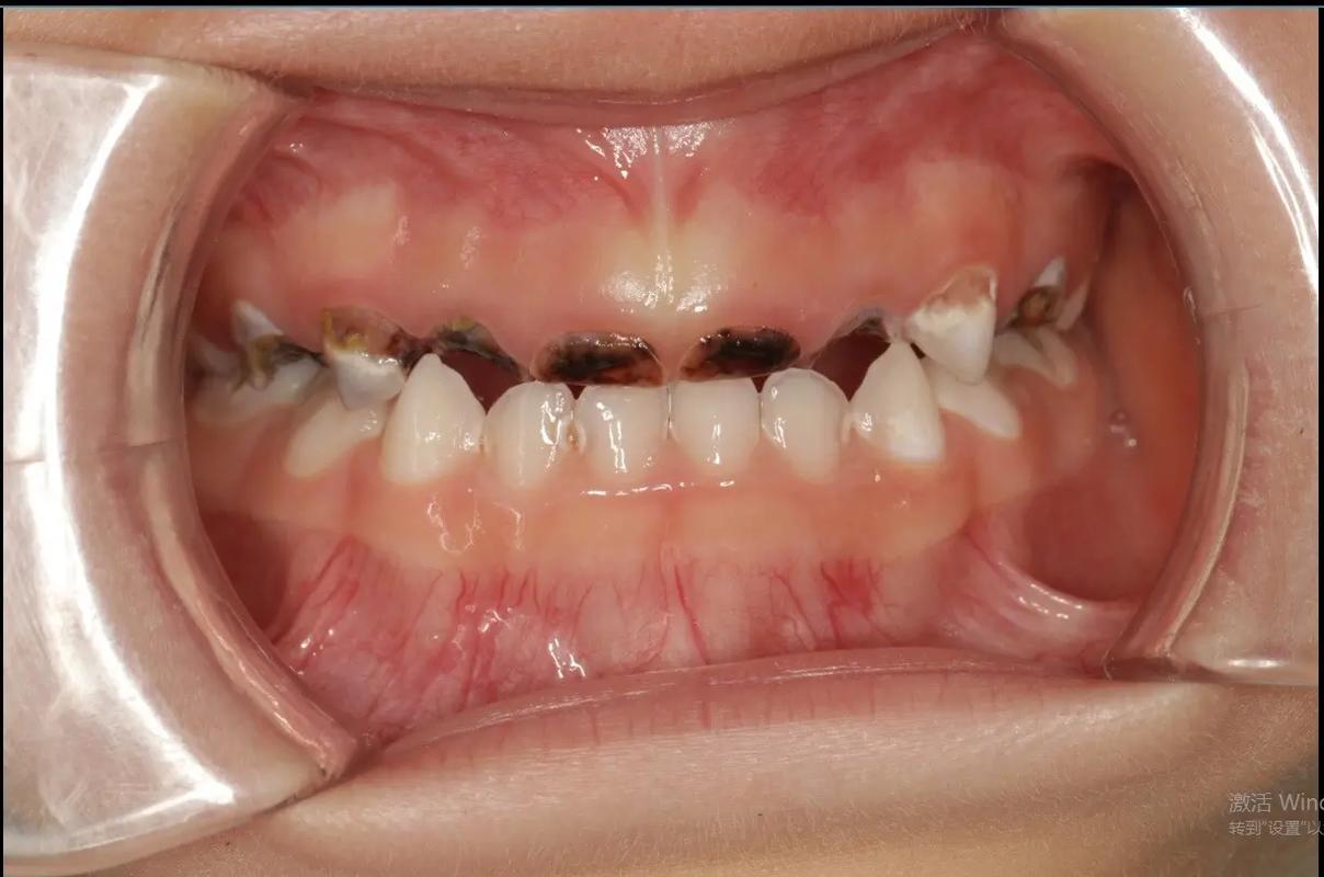 4岁娃全麻拔乳牙身亡,4岁娃全麻拔乳牙身亡率高吗