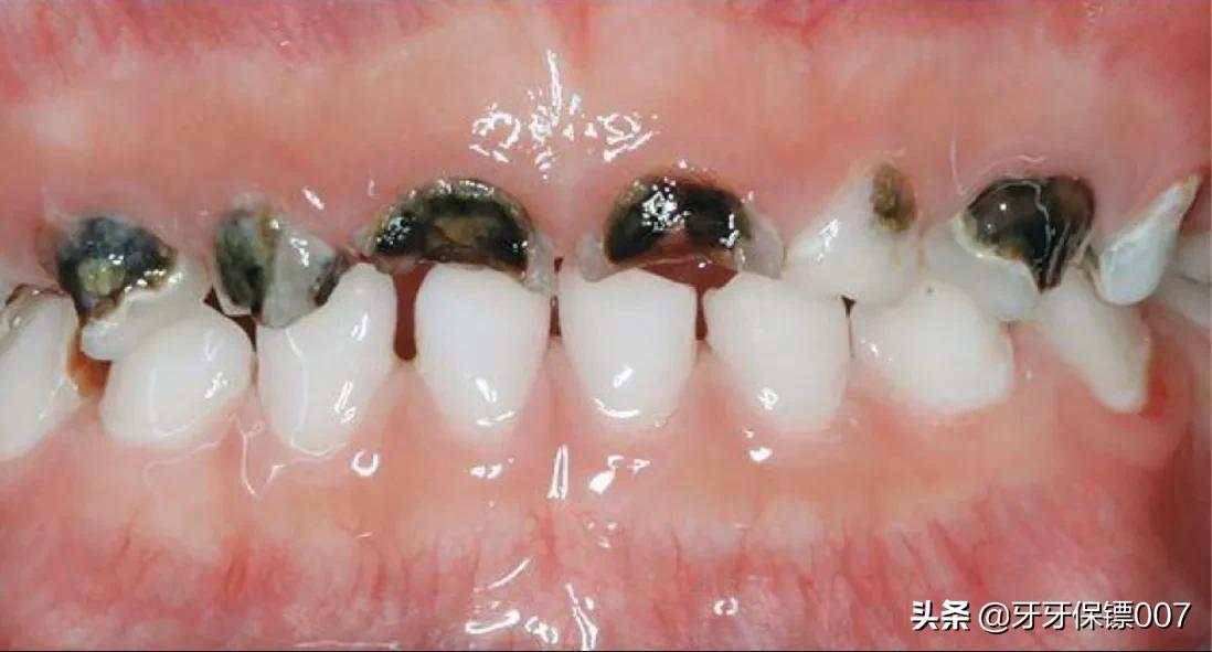 4岁娃全麻拔乳牙身亡,小孩拔牙需要打全麻吗？