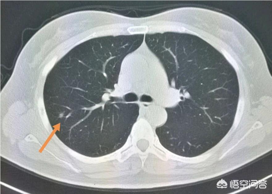 癌症的3种信号,身体患癌,会有哪些信号? 癌症的3种信号,身体患癌,会有哪些信号?