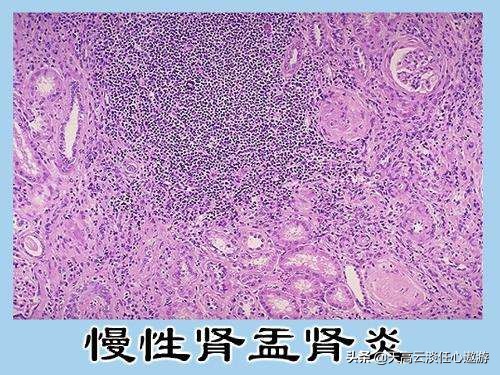 女大学生尿毒症晚期,尿毒症晚期会死吗？