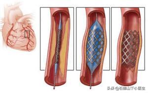 子宫肌瘤钻进心脏,子宫肌瘤钻进心脏怎么办