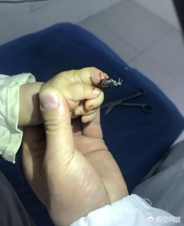 女童指尖被夹断,一根手指夹断了一小节算几级伤残？