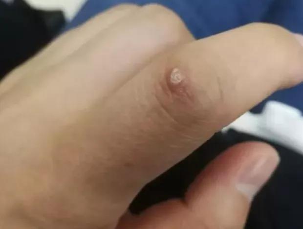 8成女性感染过HPV,女性易感染HPV病毒的最主要的原因是什么？需要怎样预防感染HPV病毒？