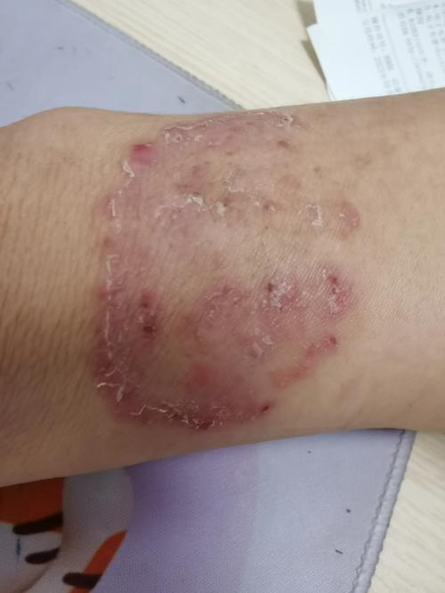 在地下室洗菜染真菌,手真菌感染能否洗菜?