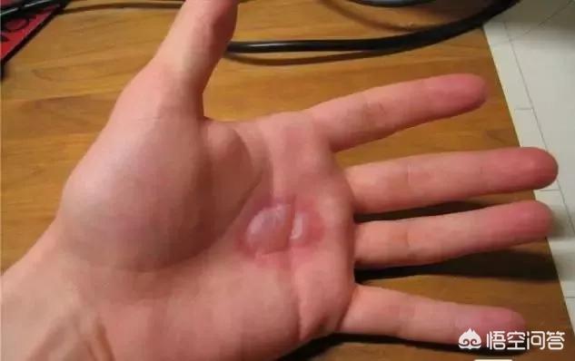 男童被沸水烫伤下肢,男童被沸水烫伤下肢怎么办