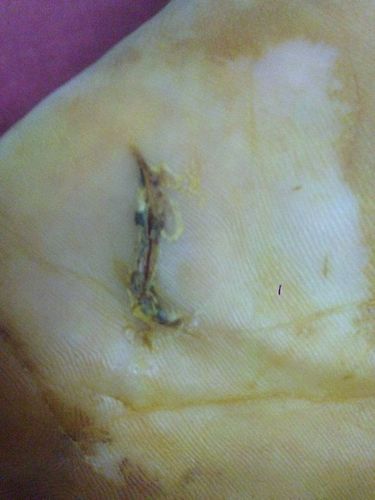 胳膊放车窗外断成3截,手臂玻璃割伤了筋工伤怎么处理?