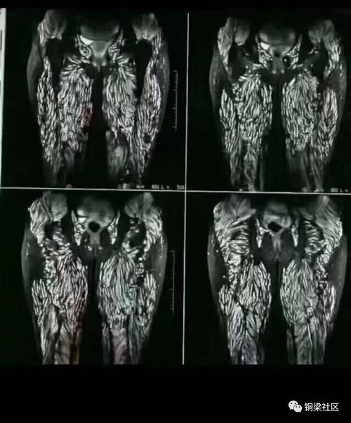 感染寄生虫仅15公斤 ,长满寄生虫体重22斤的男人是哪国人?