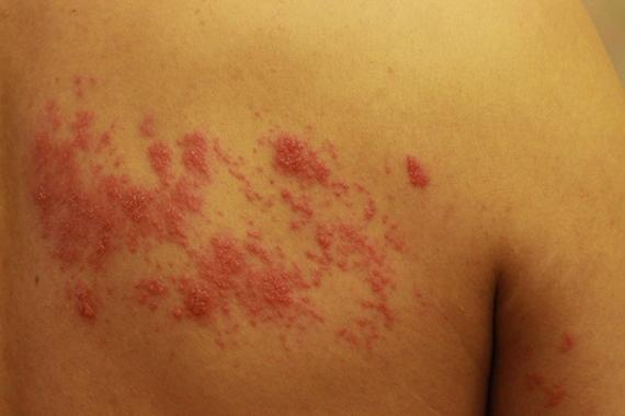 曝知名歌手患蛇缠腰,俗称“蛇缠腰”是什么病。发病时有什么症状?