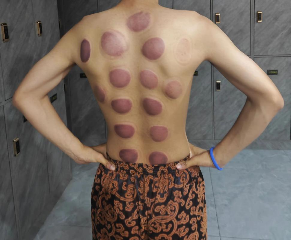 连拔2天火罐致截瘫,连拔2天火罐致截瘫能恢复吗