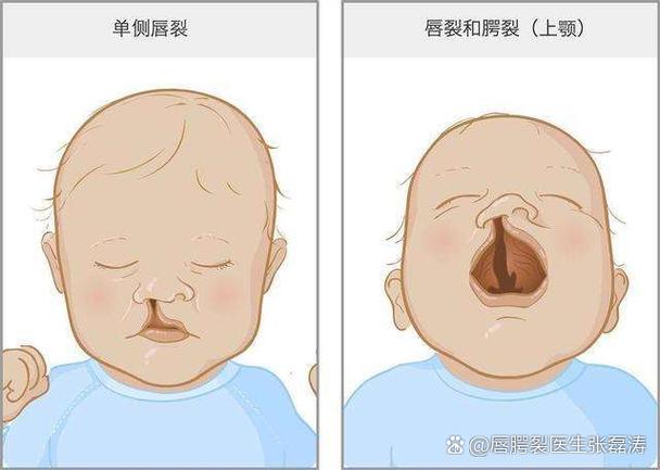 婴儿出生时脸部裂开,婴儿出生时脸部裂开怎么回事